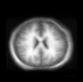 Very large brain deformation